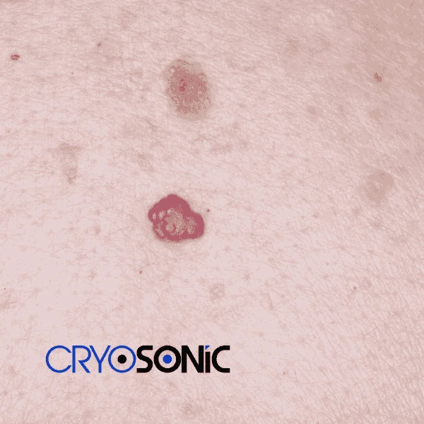 Looking for pain free cherry angioma removal treatment Billericay? Call our team today! Billericay