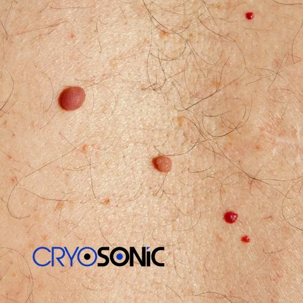 get cherry angioma removal treatment today! Billericay
