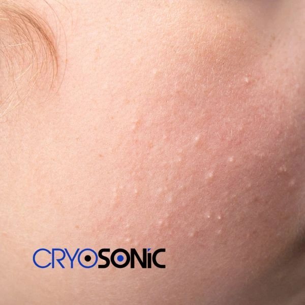 Are you looking for milia removal treatment? Contact our team today Billericay