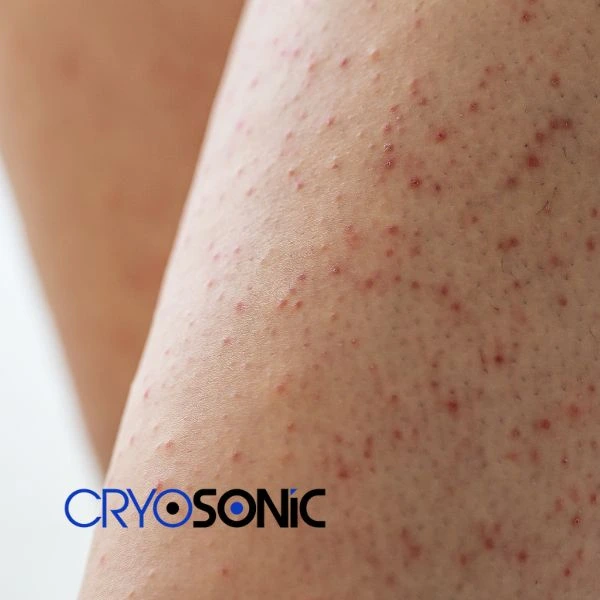 Looking for Seborrhoeic Keratosis removal Billericay treatment? Call our consultants today in Billericay