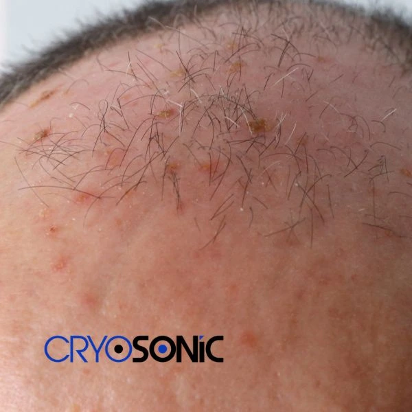 Access Seborrhoeic Keratosis removal from the comfort of your own home! Call us today in Billericay