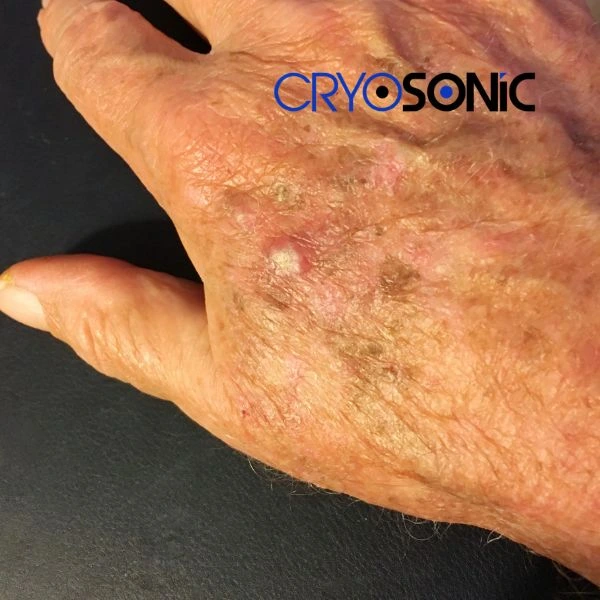 Understand more about actinic keratosis treatment today Billericay