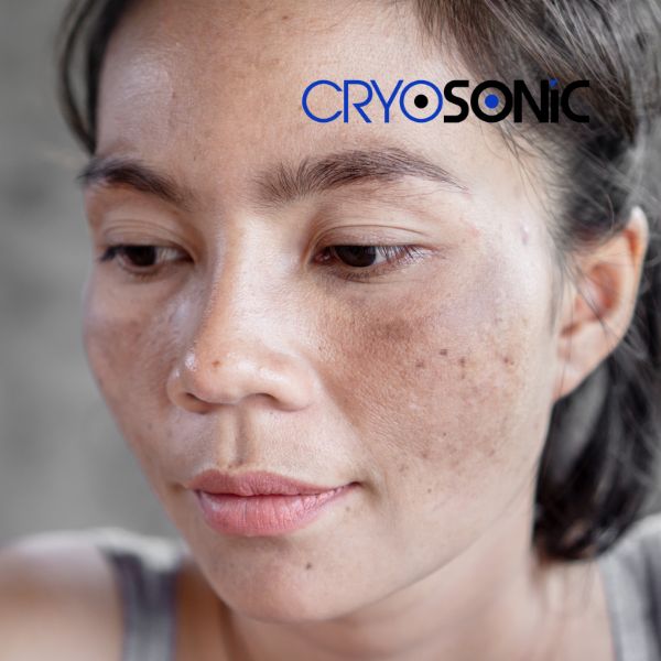 Ready to start age spots removal? Contact our team today in Billericay