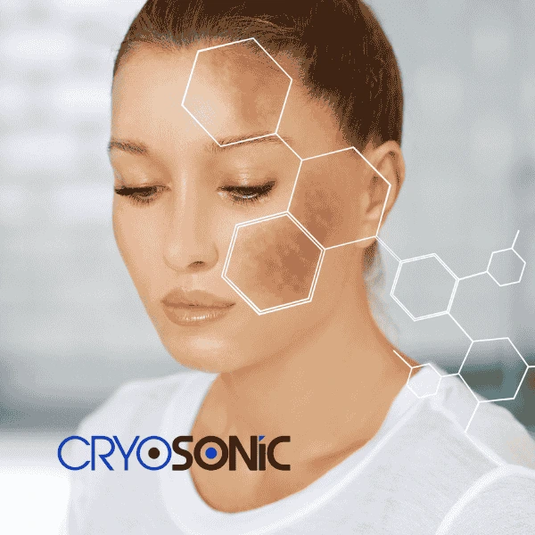 Are you looking for age spot removal treatment? Contact Cryosonic today in Billericay