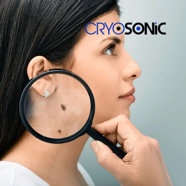 Do you want to learn more about benign moles removal treatment? Call our team today Billericay