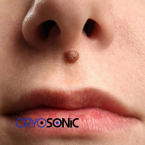 Start your benign moles removal treatment today Billericay