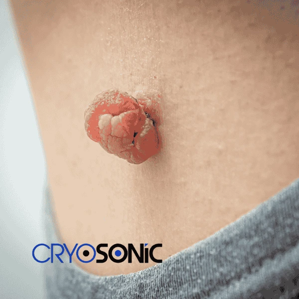 Book your skin tags removal Billericay from comfort of your own home! Billericay
