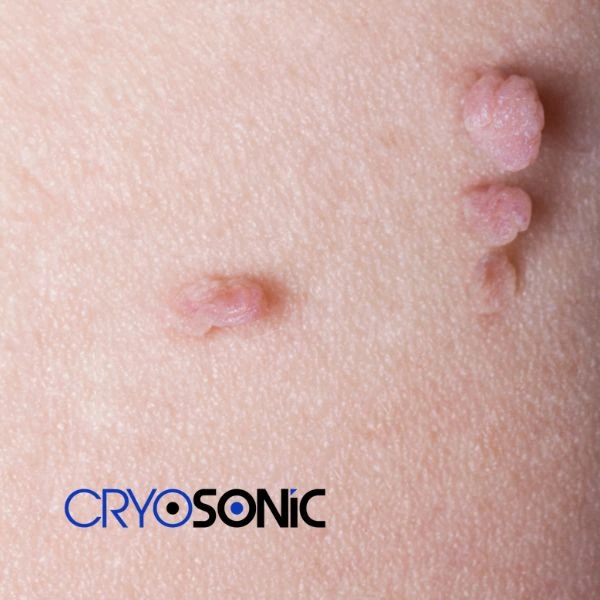 Are you looking for fast effect skin tag removal Billericay? Book in NOW! Billericay