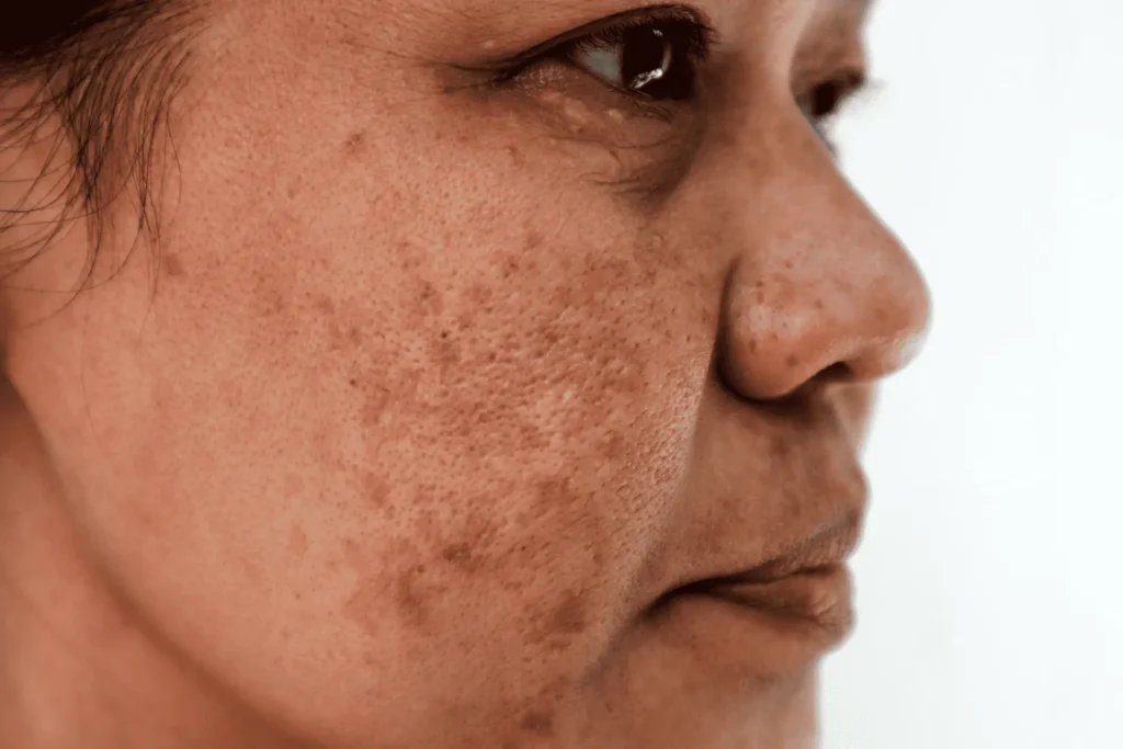 Cryosonic Repair Sun-Damaged Skin Billericay Billericay