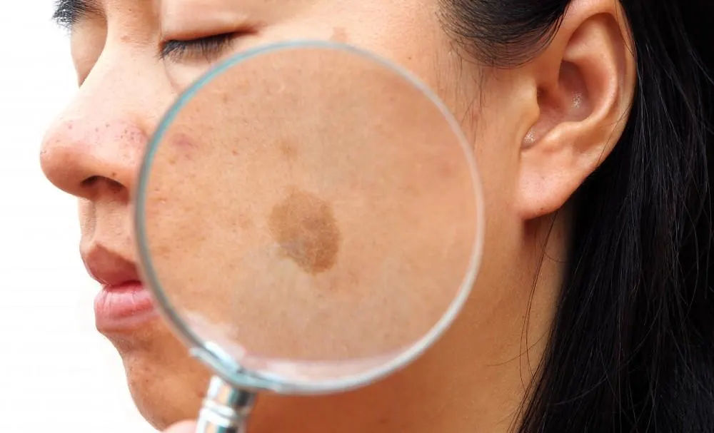 How Seborrheic Keratosis Billericay appears on the skin Billericay