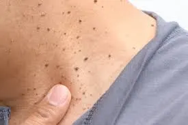 Seborrheic Keratosis: Understanding Skin Changes and CryoPen Treatment Options Billericay