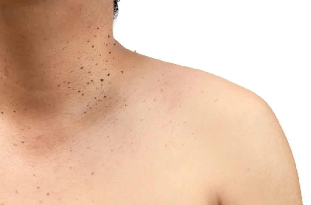 How to Maintain Healthy Skin After Treatment Billericay? Billericay