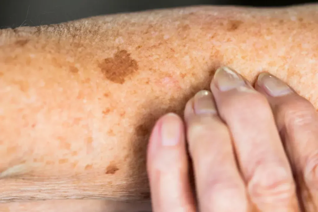 Why Is Early Treatment of Sun Damage Important Billericay? Billericay