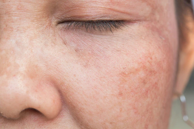UV rays affecting skin cells, showing sun damage and the need for Cryosonic repair treatments Billericay. Billericay