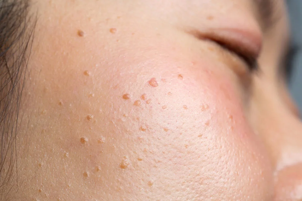 Why Choose CryoPen for Seborrheic Keratosis Billericay Billericay