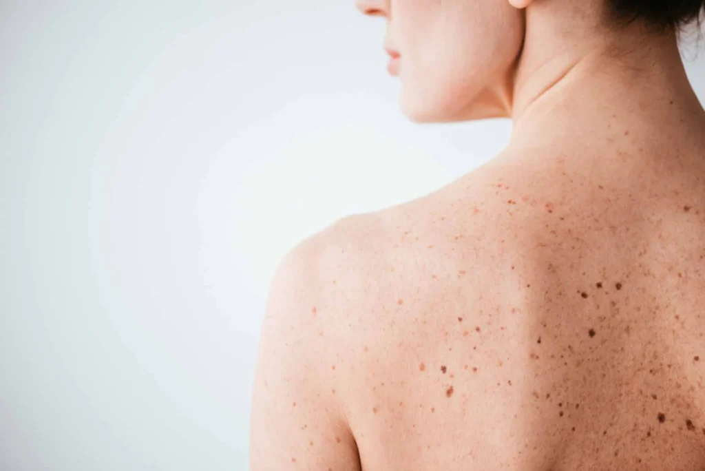 Sun Damage : Understanding UV Effects and Skin Repair Options Billericay