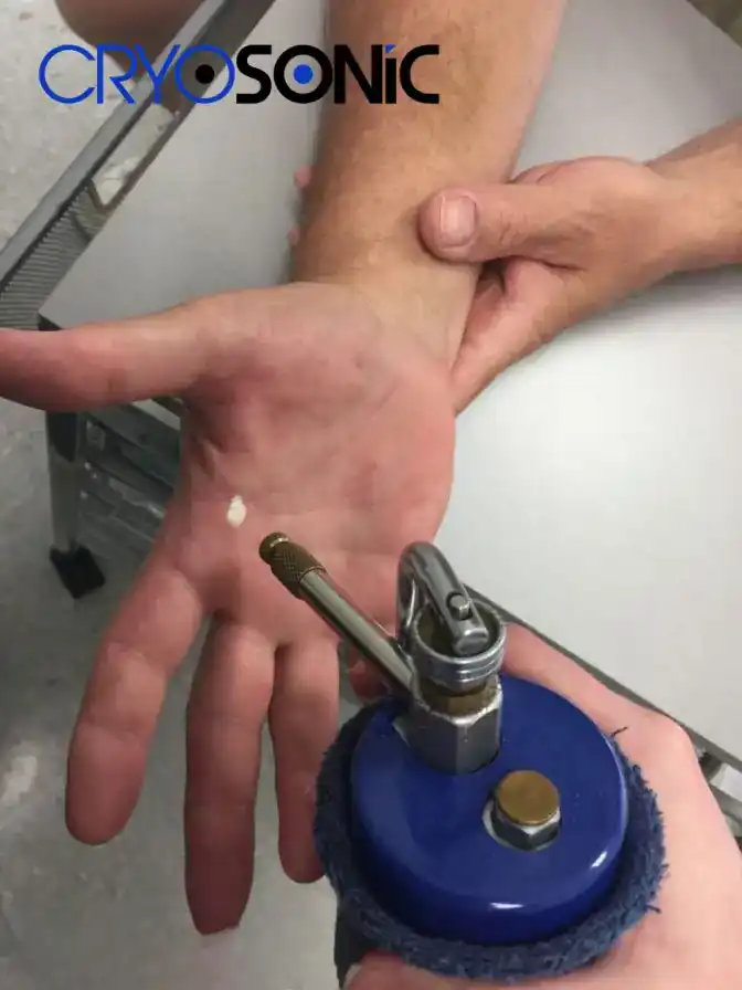 Temperature Differences: OTC vs Medical-Grade Cryotherapy Billericay